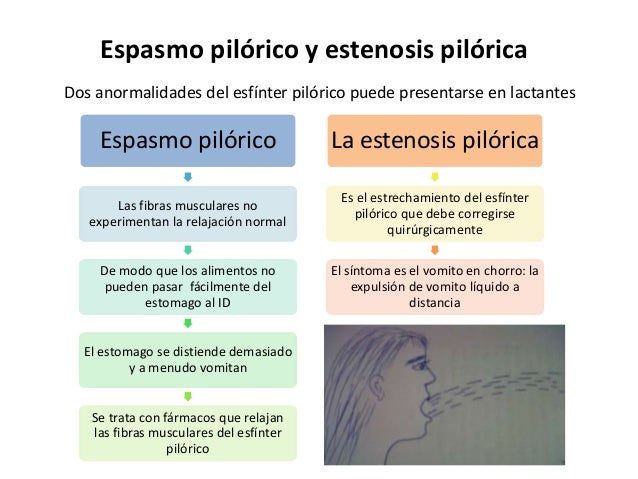 espasmo pilorico
